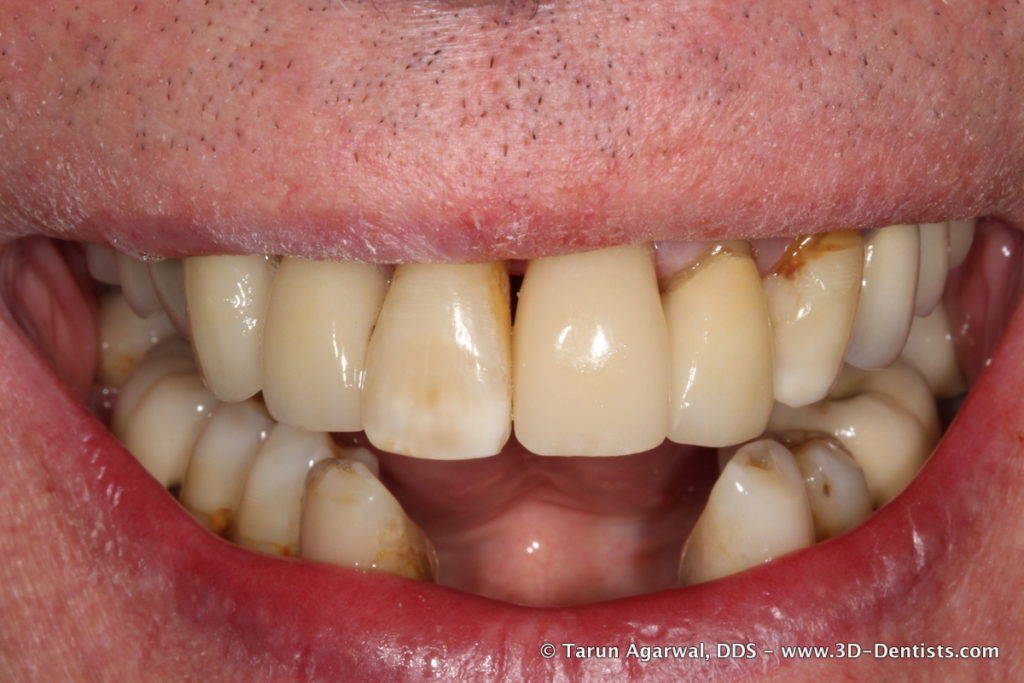 The Challenge of the Lower Anterior Implant Bridge – 3D Dentists