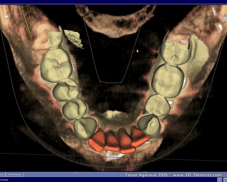 The Challenge of the Lower Anterior Implant Bridge – 3D Dentists