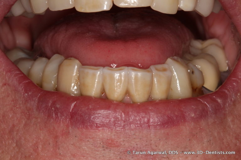 The Challenge of the Lower Anterior Implant Bridge – 3D Dentists