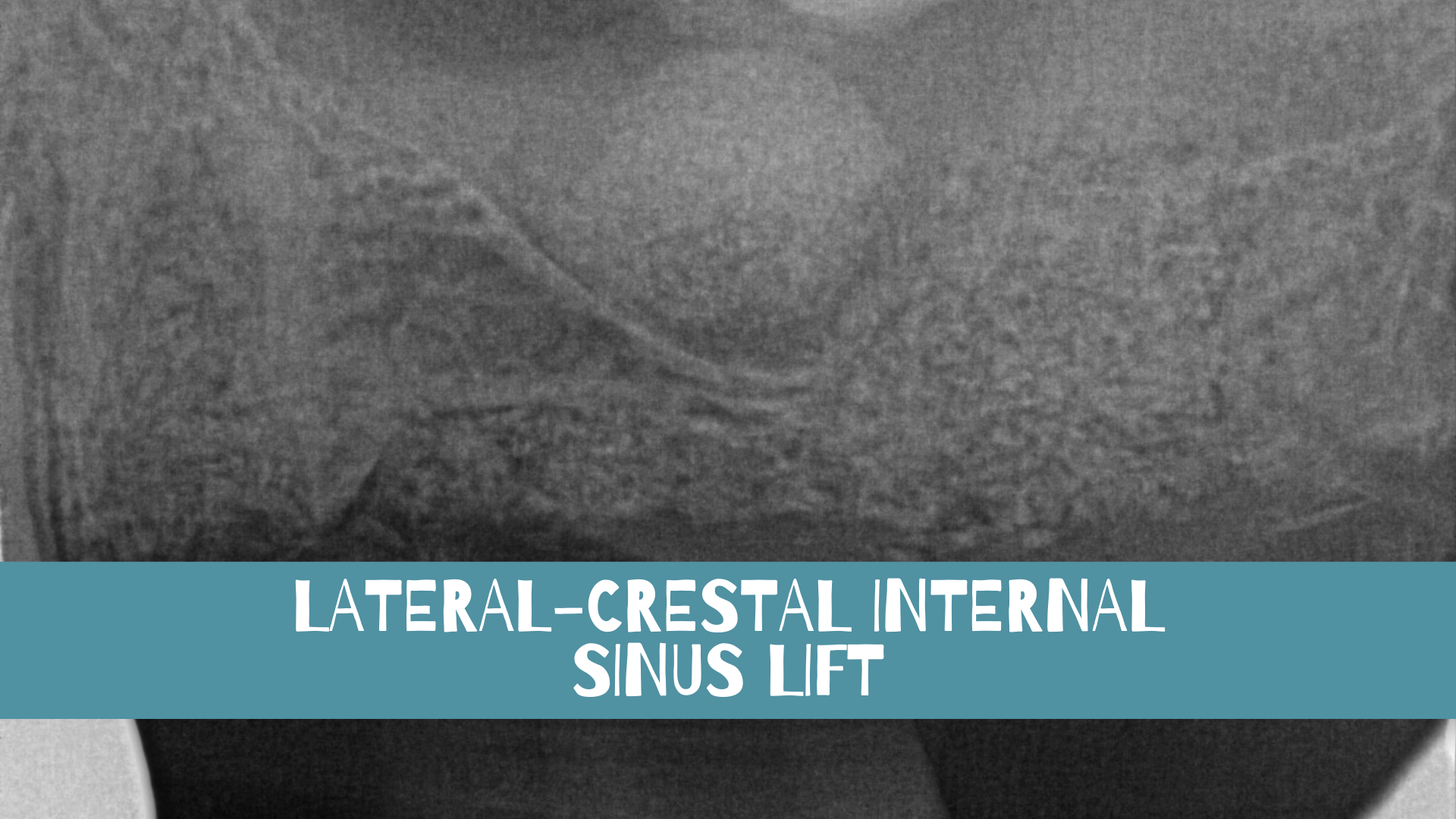 ‘Latero-Crestal’ Internal Sinus Lift At Time of Extraction