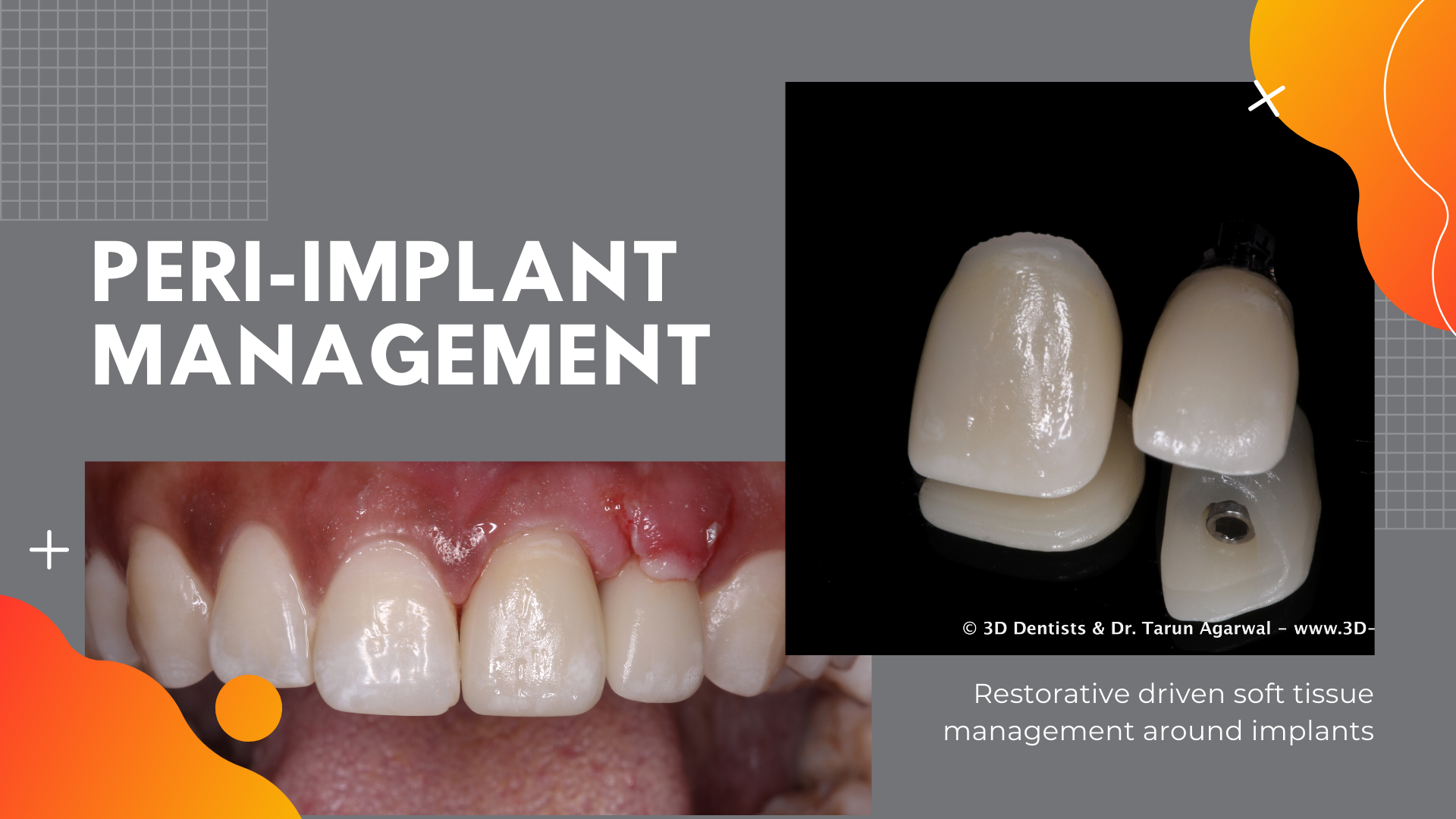 Peri-Implant Management