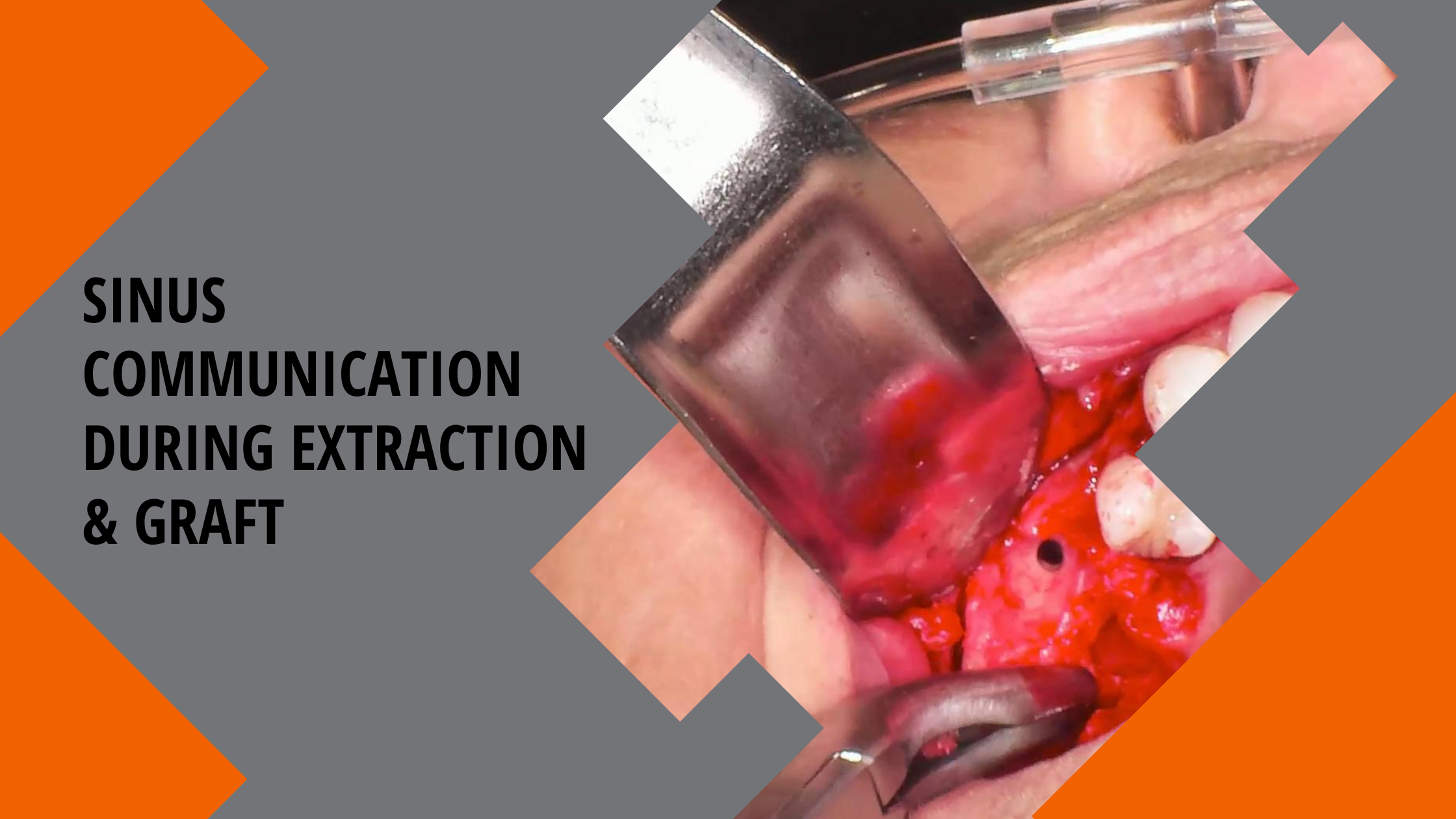 Sinus Communication with Extraction Grafting