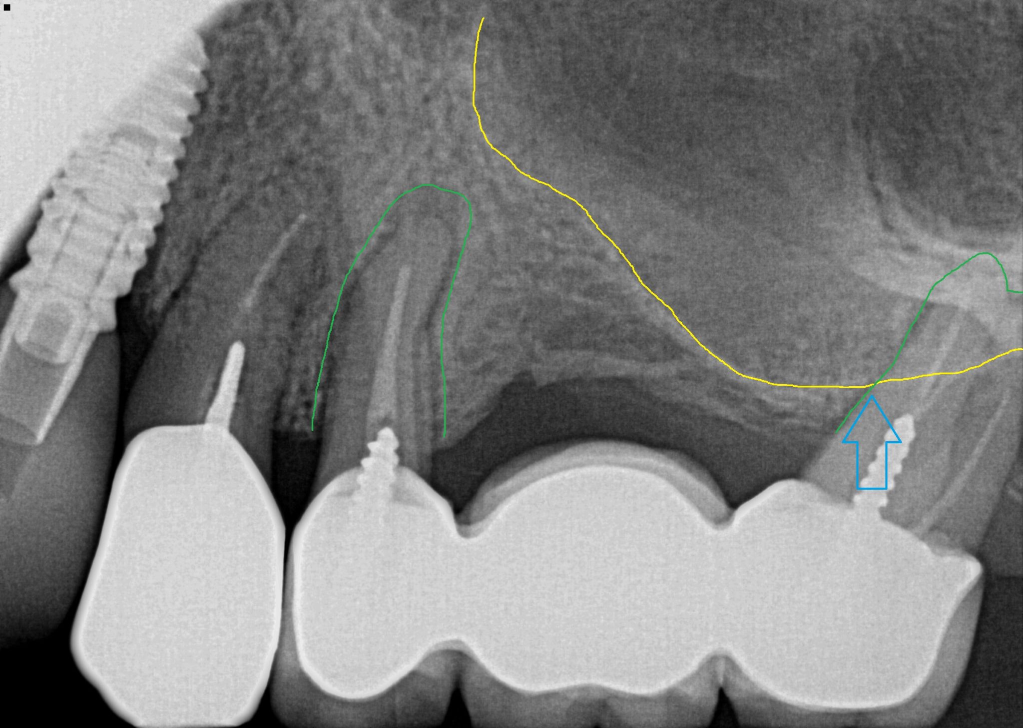 ‘LateroCrestal’ Internal Sinus Lift At Time of Extraction 3D Dentists