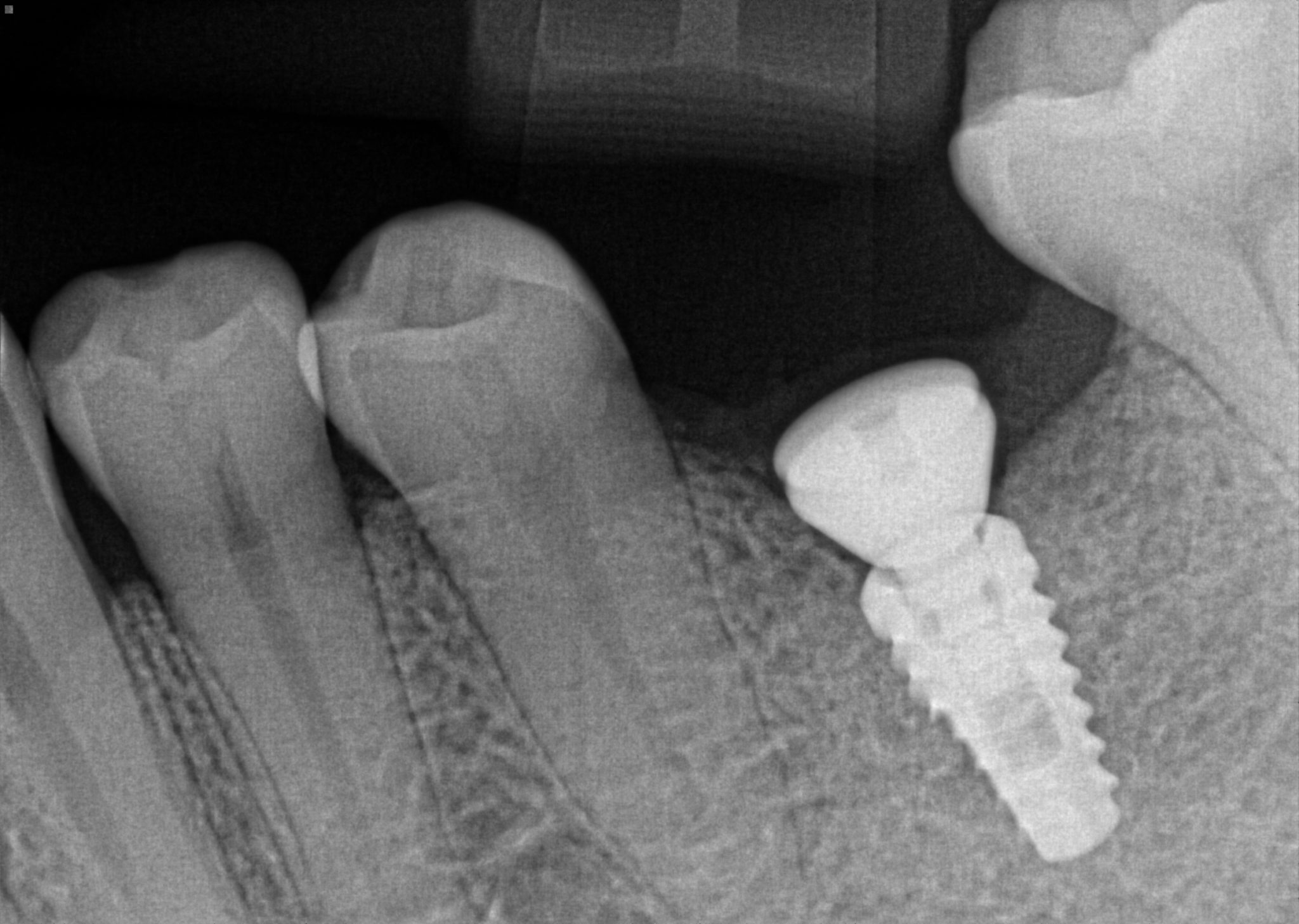 Every Dentist Placing Dental Implants Must Have One Of These! 3D Dentists