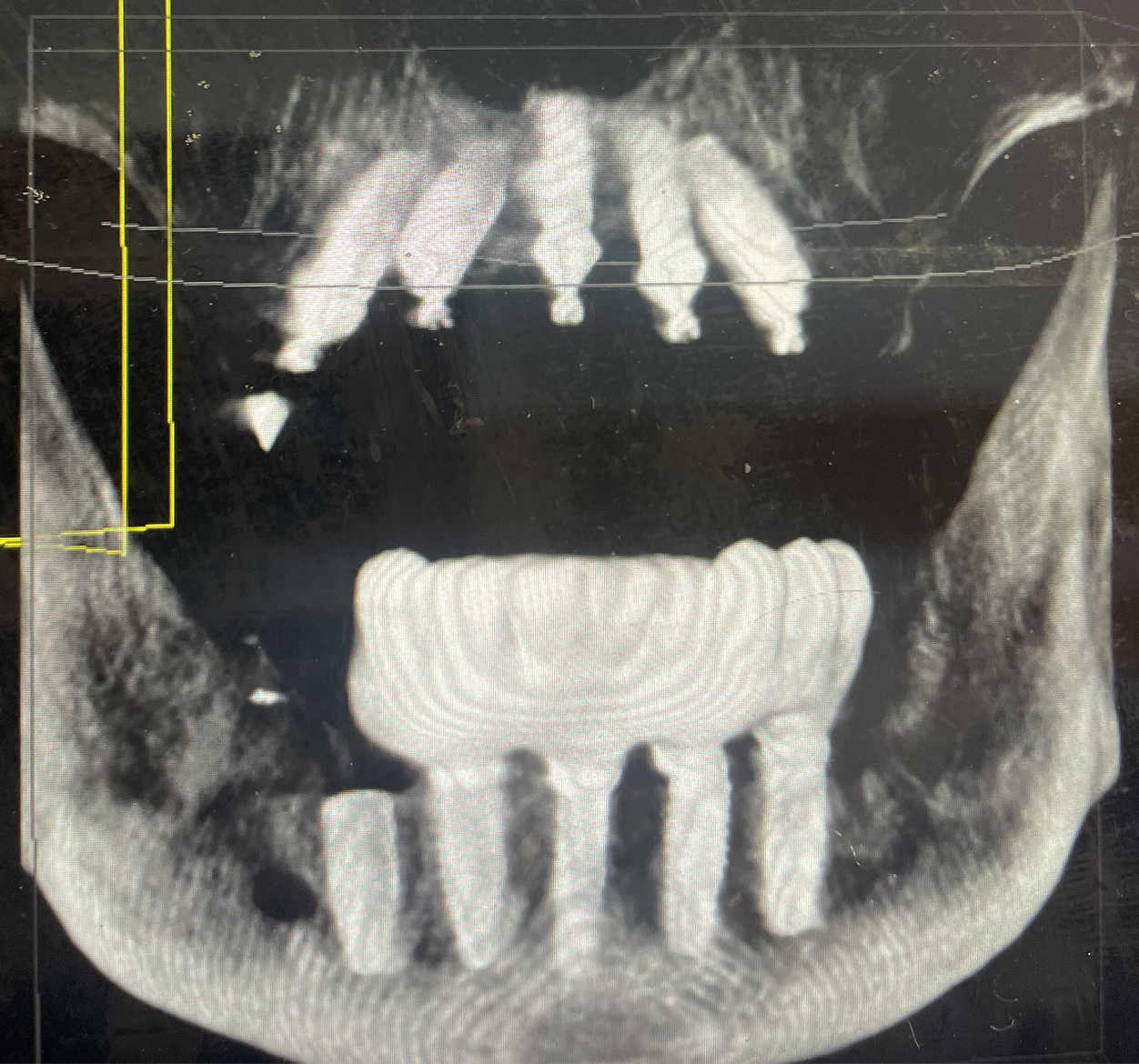 Full Arch Dentistry with Dr. Todd Larrabee